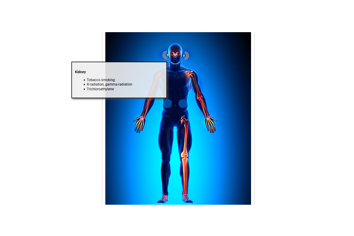 Cancer Causing Agents - Kidney