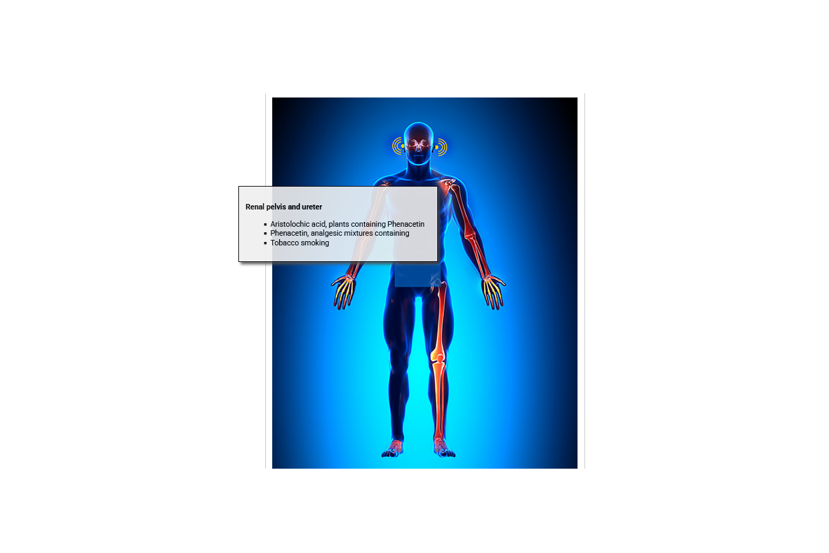 Cancer Causing Agents - Renal Pelvis